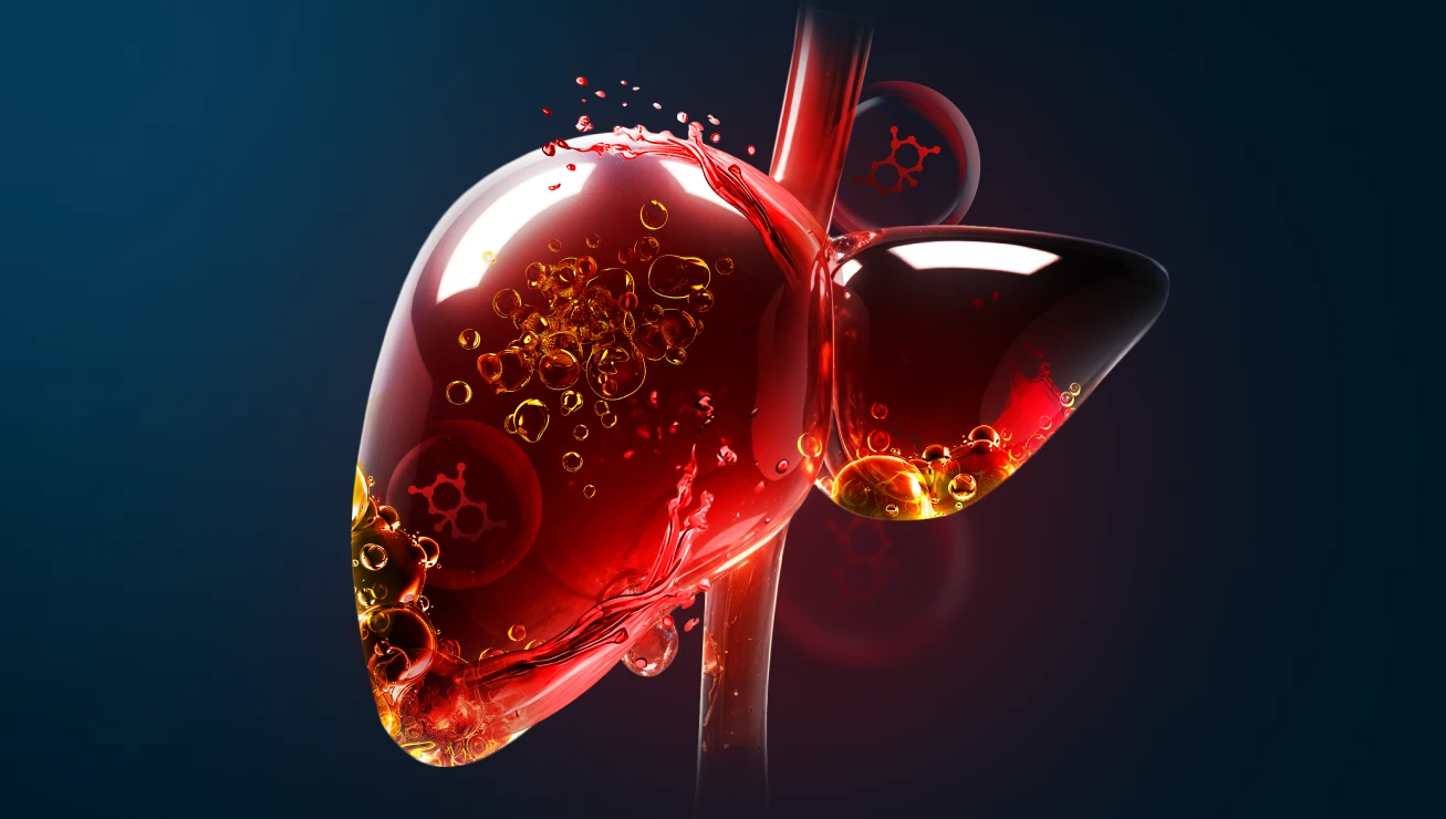 Μη αλκοολική λιπώδης ηπατική νόσος (NAFLD)
